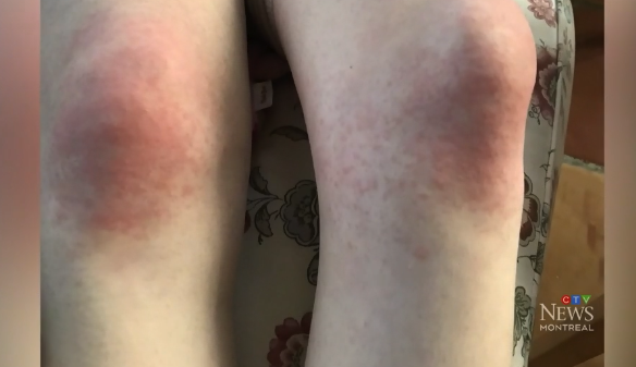 Think you hate the cold? Meet the Montreal girl who’s ‘allergic’ to it